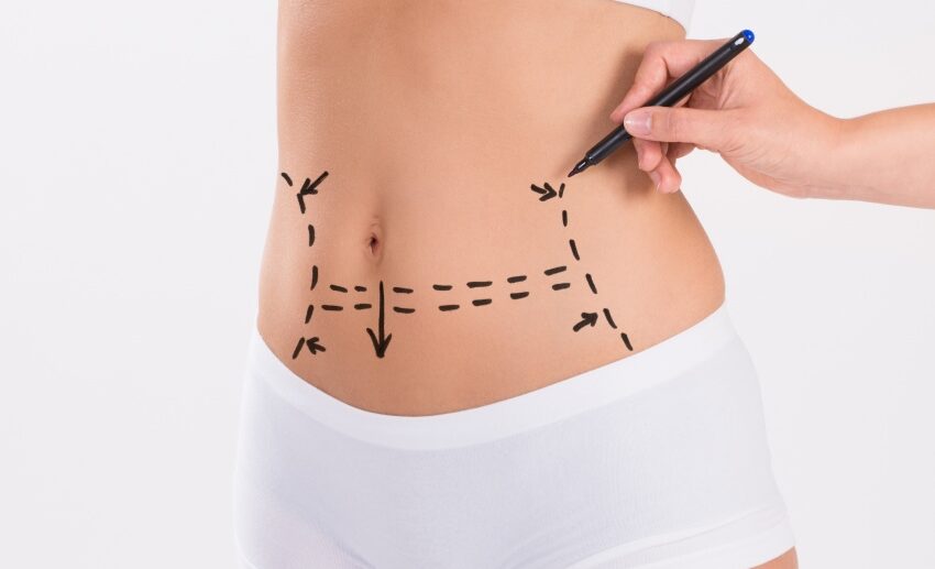 Liposuction in Istanbul, Turkey