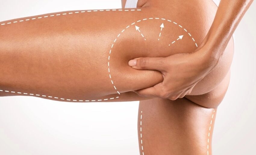 Thigh Lift in Istanbul, Turkey