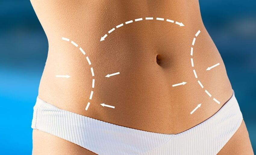 Tummy Tuck in Istanbul, Turkey